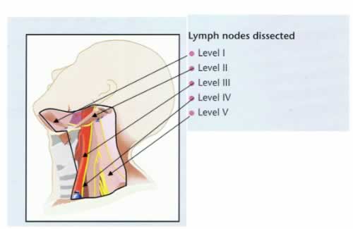 nodes in neck. Neck Nodes are divided into